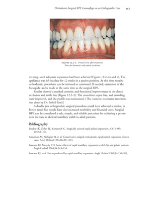 Orthodontic-Surgical RPE Camouflage on an Orthognathic Case 
evening, until adequate expansion had been achieved (Figures 12.2–4a and b). The
appliance was left in place for 12 weeks in a passive position. At this time routine
orthodontic procedures can be initiated or continued. If needed, extraction of the
bicuspids can be made at the same time as the surgical RPE.
Results showed a marked cosmetic and functional improvement in the dental
occlusion and smile line (Figure 12.2–5). The cross-bites, open bite, and crowding
were improved, and the profile was maintained. (The cosmetic restorative treatment
was done by Dr. Soheil Goel.)
A double jaw orthognathic surgical procedure could have achieved a similar, or
better, result but would have also increased morbidity and financial costs. Surgical
RPE can be considered a safe, simple, and reliable procedure for achieving a perma-
nent increase in skeletal maxillary width in adult patients.
Bibliography
Basdra EK, Zoller JE, Komposch G. Surgically assisted rapid palatal expansion. JCO 1995;
29:762–766.
Glassman AS, Nahigian SJ, et al. Conservative surgical orthodontic rapid palatal expansion: sixteen
cases. Am J Orthod 1984;86:207–213.
Isaacson RJ, Murphy TD. Some effects of rapid maxillary expansion in cleft lip and palate patients.
Angle Orthod 1964;34:143–154.
Isaacson RJ, et al. Forces produced by rapid maxillary expansion. Angle Orthod 1969;34:256–269.
 .-. Frontal view after treatment.
Note the harmonic and esthetic occlusion.
 