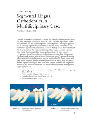 
Prosthetic orthodontics, orthodontic treatment that is usually done in prosthetic cases,
has many advantages. Treatment is usually very short, retention is permanent via the
fixed prosthesis, and it is another important source of patients. The lingual appliance
has an advantage in prosthetic patients because they are usually adults who do not
wish to have any visible labial appliances. However, the high cost of the treatment and
the speech difficulties that arise in certain stages of the lingual treatment are some-
times crucial disadvantages of the lingual appliance therapy in those patients.
Segmental lingual preprosthetic orthodontics can overcome these disadvantages.
Good esthetics is achieved with the lingual brackets, the cost of a segmental treatment
is lower compared to a full treatment, and it is more comfortable for the patient with
fewer speech problems. Small orthodontic problems can be solved easily and quickly
with the segmental technique. Some of the most frequent problems that the prostho-
dontists ask the orthodontists to treat, and which can be easily solved with segmented
lingual appliance are:
1. Uprighting of molars with space closure (Figure 13.1–1) or with space opening
(Figure 13.1–2).
2. Forced eruption (Figures 13.1–3a and b).
3. Lingual or buccal cross-bites (Figure 13.1–4).
4. Teeth rotations (Figure 13.1–5).
 .
Segmental Lingual
Orthodontics in
Multidisciplinary Cases
PABLO A. ECHARRI, DDS
 .-. Uprighting of a mesially tipped molar
with space closure.
 .-. Uprighting of a mesially tipped molar
with space opening.
1'' ARCO
 
