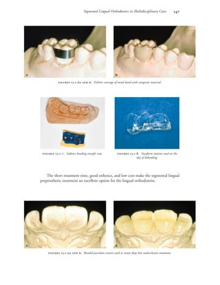 Segmental Lingual Orthodontics in Multidisciplinary Cases 
The short treatment time, good esthetics, and low cost make the segmental lingual
preprosthetic treatment an excellent option for the lingual orthodontist.
 .-  . Esthetic coverage of metal band with composite material.
 .-. Indirect bonding transfer tray.  .-. Vacuform retainer used on the
day of debonding.
 
 .-  . Bonded porcelain veneers used to retain deep bite malocclusion treatment.
 
 