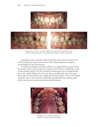  
Eventually, he was convinced to debond only four of the anterior brackets (2-2),
and, fortunately, this improved his reaction. The treatment plan was changed to
accommodate the new circumstances.
A combined orthodontic–prosthetic solution was suggested because space closure
by retraction of the anterior segment and overjet closure was now excluded due to the
anterior bracket removal. The new immediate treatment plan was to orthodontically
retract the cuspids distally and at the same time to prosthetically restore the spaces
that would now open between the cuspids and the lateral incisors. The use of a hybrid
composite resin to close the spaces would allow periodic adjustments during ortho-
dontic movement to maintain normal and esthetic function.
 .-  . At initial orthodontic examination: frontal and lateral views.
Note the unesthetic space between the cuspid and first premolar, and the rotated cuspid.

 
 .-. Occlusal maxillary view:
lingual Ormco brackets, segmental technique.
 