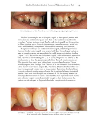 Combined Orthodontic-Prosthetic Treatment of Malpositioned Anterior Teeth 
The final treatment plan was to bring the cuspids to their optimal position with
no rotation and with minimal spaces from them to the lateral incisors and to the
premolars. Porcelain laminates would then be made for the cuspids and first premolars
to fill the proximal spaces. Porcelain laminates were chosen because they would pro-
vide a stable and long lasting esthetic solution while conserving tooth structure.
A segmental technique was used to retract the cuspids, and the lingual buttons
that were bonded on the cuspids were replaced with Kurz-Ormco lingual brackets as
soon as enough retraction was accomplished to enable single-tooth indirect bonding
(Figure 13.2–2). Because the retraction of the cuspids caused an unesthetic appearance
after 3 months of treatment (Figures 13.2–3a and b), the patient was referred to the
prosthodontist to close the spaces temporarily. Since the tooth rotation was not yet
fully corrected, large spaces were evident in the interdental papillae areas. Using a
hybrid composite resin (Prodigy, Kerr, Glendora, CA), the distocervical surfaces of the
lateral incisors were widened (Figures 13.2–4a and b). The mesial surfaces of the cus-
pids were augmented with the resin to create rotation illusion in a distobuccal direc-
tion and to close the existing spaces, allowing the formation of a healthy interdental
papillae. Since most natural cuspids are asymmetrical, this discrepancy between the
homological teeth was used to create a natural and balanced asymmetry. Four months
later, when the cuspids were orthodontically brought to their final positions, the
patient was referred again to the prosthodontist for completion of the treatment.
 
 .-  . Lateral views during treatment. Note the space opening during the cuspid retraction.
 
 .-  . Temporary composite resin restorations: Hybrid composite resin bonded incrementally
to the distocervical surfaces of the lateral incisors, and mesial aspects of the canine.
 
