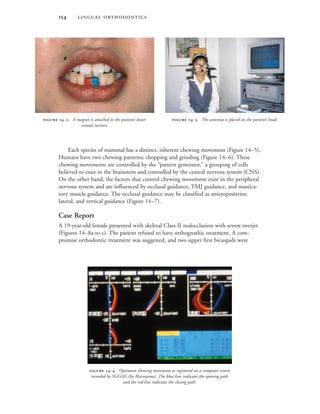  
Each species of mammal has a distinct, inherent chewing movement (Figure 14–5).
Humans have two chewing patterns; chopping and grinding (Figure 14–6). These
chewing movements are controlled by the “pattern generator,” a grouping of cells
believed to exist in the brainstem and controlled by the central nervous system (CNS).
On the other hand, the factors that control chewing movement exist in the peripheral
nervous system and are influenced by occlusal guidance, TMJ guidance, and mastica-
tory muscle guidance. The occlusal guidance may be classified as anteroposterior,
lateral, and vertical guidance (Figure 14–7).
Case Report
A 19-year-old female presented with skeletal Class II malocclusion with severe overjet
(Figures 14–8a to c). The patient refused to have orthognathic treatment. A com-
promise orthodontic treatment was suggested, and two upper first bicuspids were
 -. A magnet is attached to the patient’s lower
central incisors.
 -. The antenna is placed on the patient’s head.
 -. Optimum chewing movement as registered on a computer screen
recorded by SGG/AS (by Maruyama). The blue line indicates the opening path
and the red line indicates the closing path.
 