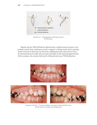  -  . At initial orthodontic examination: frontal and lateral views.
Note the open bite, crowding, and enlarged overjet.

 
 
Muscles and the TMJ will both be affected when a dysfunctional occlusion is not
properly treated. Every masticatory muscle comprises a closing muscle and an opening
muscle and each of them has two functions, yielding protrusive and retrusive forces.
An abnormal protrusive shift will cause pain and spasm in the lateral pterygoid muscle;
if this continues, the articular disk may be dislocated and cause TMJ dysfunction.
 -. Occlusal guidance of chewing movement
(by Maruyama).
Anteroposterior guidance
Lateral guidance
Vertical guidance
 