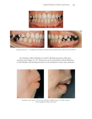 Lingual Orthodontics: Esthetics and Function 
An articulator called a Palculator is used for checking movements when poor
occlusion exists (Figure 14–15). Dental casts can be moved freely without limitation
on the Palculator and chewing movement can be simulated. In many cases, abnormal
 -  . At completion of orthodontic treatment: frontal and lateral views. Note the Class II occlusion.

 
 
 -  . Close-up view of the lips: (a) Before treatment. (b) After treatment.
Note the significant changes in lips closure.
 