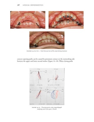  
 -. Chewing patterns using sirognathograph
analyzing system when gum is chewed.
 

 -  . Serial close-up views of the overjet during treatment.
concave opening paths can be caused by premature contact on the nonworking side
between the upper and lower second molars (Figure 14–16). When closing paths
 