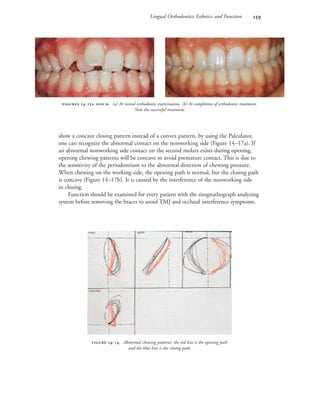 Lingual Orthodontics: Esthetics and Function 
show a concave closing pattern instead of a convex pattern, by using the Palculator,
one can recognize the abnormal contact on the nonworking side (Figure 14–17a). If
an abnormal nonworking side contact on the second molars exists during opening,
opening chewing patterns will be concave to avoid premature contact. This is due to
the sensitivity of the periodontium to the abnormal direction of chewing pressure.
When chewing on the working side, the opening path is normal, but the closing path
is concave (Figure 14–17b). It is caused by the interference of the nonworking side
in closing.
Function should be examined for every patient with the sirognathograph analyzing
system before removing the braces to avoid TMJ and occlusal interference symptoms.
 -. Abnormal chewing patterns: the red line is the opening path
and the blue line is the closing path.
 -  . (a) At initial orthodontic examination. (b) At completion of orthodontic treatment.
Note the successful treatment.
 
 