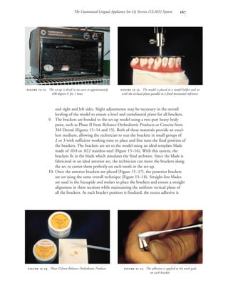 The Customized Lingual Appliance Set-Up Service (CLASS) System 
and right and left sides. Slight adjustments may be necessary in the overall
leveling of the model to ensure a level and coordinated plane for all brackets.
9. The brackets are bonded to the set-up model using a two-part heavy body
paste, such as Phase II from Reliance Orthodontic Products or Concise from
3M Dental (Figures 15–14 and 15). Both of these materials provide an excel-
lent medium, allowing the technician to seat the brackets in small groups of
2 or 3 with sufficient working time to place and fine tune the final position of
the brackets. The brackets are set to the model using an ideal template blade
made of .018 or .022 stainless steel (Figure 15–16). With this system, the
brackets fit in the blade which simulates the final archwire. Since the blade is
fabricated in an ideal anterior arc, the technician can move the brackets along
the arc to center them perfectly on each tooth in the set-up.
10. Once the anterior brackets are placed (Figure 15–17), the posterior brackets
are set using the same overall technique (Figure 15–18). Straight-line blades
are used in the bicuspids and molars to place the brackets and ensure a straight
alignment in these sections while maintaining the uniform vertical plane of
all the brackets. As each bracket position is finalized, the excess adhesive is
 -. Phase II from Reliance Orthodontic Products.  -. The adhesion is applied to the mesh pads
on each bracket.
 -. The set-up is dried in an oven at approximately
100 degrees F. for 1 hour.
 -. The model is placed in a model holder and set
with the occlusal plane parallel to a fixed horizontal reference.
 