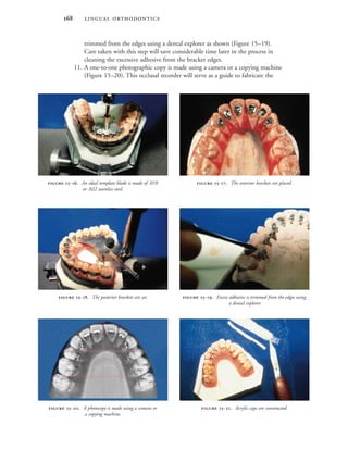  
trimmed from the edges using a dental explorer as shown (Figure 15–19).
Care taken with this step will save considerable time later in the process in
cleaning the excessive adhesive from the bracket edges.
11. A one-to-one photographic copy is made using a camera or a copying machine
(Figure 15–20). This occlusal recorder will serve as a guide to fabricate the
 -. An ideal template blade is made of .018
or .022 stainless steel.
 -. The anterior brackets are placed.
 -. A photocopy is made using a camera or
a copying machine.
 -. Acrylic caps are constructed.
 -. The posterior brackets are set.  -. Excess adhesive is trimmed from the edges using
a dental explorer.
 