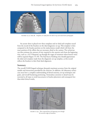 The Customized Lingual Appliance Set-Up Service (CLASS) System 
An acetate sheet is placed over these templates and an ideal arch template traced
from the record of the brackets on the ideal diagnostic set-up. This template is then
compared to the bracket position on the malocclusion model which will show the
exact position of the offsets that are necessary, distal to the canines. The technician
can then estimate the amount of wire required in the anterior arch from the beginning
wire, such as a .0175 Respond, up through the stages of treatment where heavier wires
will be required (Figure 15–39). The final heavy finishing wire should approximate
the ideal arch template made from the diagnostic set-up template, as this record
reflects the brackets in their final ideal alignment.
Summary
The overall CLASS lingual technique demands maximum accuracy from the original
models and instructions provided by the clinician. In addition, the laboratory techni-
cian must have a complete understanding of dental anatomy, set-up techniques and
goals, and overall bracketing positioning. Tremendous attention to detail must be
exercised at all steps to avoid inaccuracies in bracket placement and consequent less-
than-ideal clinical results.
 -  . Templates are made from the ideal set-up and malocclusion photographs.
 -. Wires required from the beginning wire through
the successive stages of treatment.
 