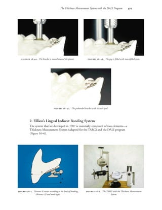 The Thickness Measurement System with the DALI Program 
2. Fillion’s Lingual Indirect Bonding System
The system that we developed in 1987 is essentially composed of two elements—a
Thickness Measurement System (adapted for the TARG) and the DALI program
(Figure 16–6).
 -. The bracket is moved toward the plaster.  -. The gap is filled with macrofilled resin.
 -. The prebonded bracket with its resin pad.
 -. Distance B varies according to the level of bonding
(distance A) and tooth type.
 -. The TARG with the Thickness Measurement
System.
 