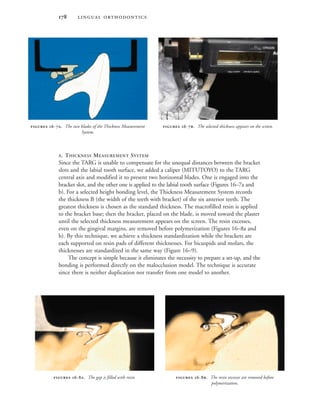  
A. THICKNESS MEASUREMENT SYSTEM
Since the TARG is unable to compensate for the unequal distances between the bracket
slots and the labial tooth surface, we added a caliper (MITUTOYO) to the TARG
central axis and modified it to present two horizontal blades. One is engaged into the
bracket slot, and the other one is applied to the labial tooth surface (Figures 16–7a and
b). For a selected height bonding level, the Thickness Measurement System records
the thickness B (the width of the teeth with bracket) of the six anterior teeth. The
greatest thickness is chosen as the standard thickness. The macrofilled resin is applied
to the bracket base; then the bracket, placed on the blade, is moved toward the plaster
until the selected thickness measurement appears on the screen. The resin excesses,
even on the gingival margins, are removed before polymerization (Figures 16–8a and
b). By this technique, we achieve a thickness standardization while the brackets are
each supported on resin pads of different thicknesses. For bicuspids and molars, the
thicknesses are standardized in the same way (Figure 16–9).
The concept is simple because it eliminates the necessity to prepare a set-up, and the
bonding is performed directly on the malocclusion model. The technique is accurate
since there is neither duplication nor transfer from one model to another.
 -. The two blades of the Thickness Measurement
System.
 -. The selected thickness appears on the screen.
 -. The gap is filled with resin.  -. The resin excesses are removed before
polymerization.
 