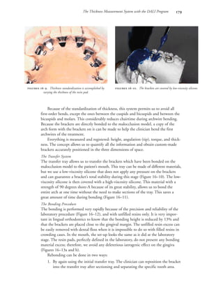 The Thickness Measurement System with the DALI Program 
Because of the standardization of thickness, this system permits us to avoid all
first-order bends, except the ones between the cuspids and bicuspids and between the
bicuspids and molars. This considerably reduces chairtime during archwire bending.
Because the brackets are directly bonded to the malocclusion model, a copy of the
arch form with the brackets on it can be made to help the clinician bend the first
archwires of the treatment.
Everything is measured and registered: height, angulation (tip), torque, and thick-
ness. The concept allows us to quantify all the information and obtain custom-made
brackets accurately positioned in the three dimensions of space.
The Transfer System
The transfer tray allows us to transfer the brackets which have been bonded on the
malocclusion model to the patient’s mouth. This tray can be made of different materials,
but we use a low-viscosity silicone that does not apply any pressure on the brackets
and can guarantee a bracket’s total stability during this stage (Figure 16–10). The low-
viscosity silicone is then covered with a high-viscosity silicone. This material with a
strength of 90 degrees shore-A because of its great stability, allows us to bond the
entire arch at one time without the need to make sections of the tray. This saves a
great amount of time during bonding (Figure 16–11).
The Bonding Procedure
The bonding is performed very rapidly because of the precision and reliability of the
laboratory procedure (Figure 16–12), and with unfilled resins only. It is very impor-
tant in lingual orthodontics to know that the bonding height is reduced by 13% and
that the brackets are placed close to the gingival margin. The unfilled resin excess can
be easily removed with dental floss when it is impossible to do so with filled resins in
crowding cases. In the mouth, the set-up looks the same as it did at the laboratory
stage. The resin pads, perfectly defined in the laboratory, do not present any bonding
material excess; therefore, we avoid any deleterious iatrogenic effect on the gingiva
(Figures 16–13a and b).
Rebonding can be done in two ways:
1. By again using the initial transfer tray. The clinician can reposition the bracket
into the transfer tray after sectioning and separating the specific tooth area.
 -. Thickness standardization is accomplished by
varying the thickness of the resin pad.
 -. The brackets are covered by low-viscosity silicone.
 