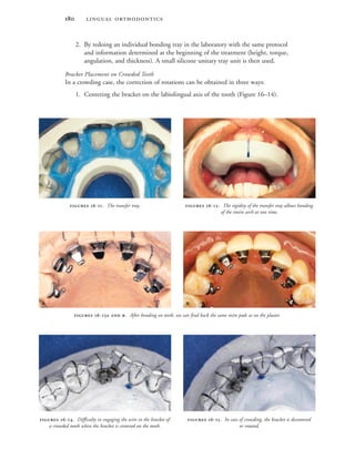  
2. By redoing an individual bonding tray in the laboratory with the same protocol
and information determined at the beginning of the treatment (height, torque,
angulation, and thickness). A small silicone unitary tray unit is then used.
Bracket Placement on Crowded Teeth
In a crowding case, the correction of rotations can be obtained in three ways:
1. Centering the bracket on the labiolingual axis of the tooth (Figure 16–14).
 -. The transfer tray.  -. The rigidity of the transfer tray allows bonding
of the entire arch at one time.
 -. Difficulty in engaging the wire in the bracket of
a crowded tooth when the bracket is centered on the tooth.
 -. In case of crowding, the bracket is decentered
or rotated.
 -  . After bonding on teeth, we can find back the same resin pads as on the plaster.
 
 