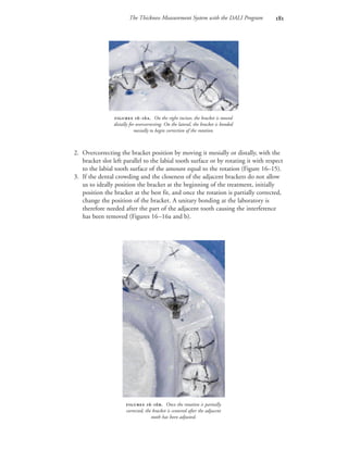 The Thickness Measurement System with the DALI Program 
2. Overcorrecting the bracket position by moving it mesially or distally, with the
bracket slot left parallel to the labial tooth surface or by rotating it with respect
to the labial tooth surface of the amount equal to the rotation (Figure 16–15).
3. If the dental crowding and the closeness of the adjacent brackets do not allow
us to ideally position the bracket at the beginning of the treatment, initially
position the bracket at the best fit, and once the rotation is partially corrected,
change the position of the bracket. A unitary bonding at the laboratory is
therefore needed after the part of the adjacent tooth causing the interference
has been removed (Figures 16–16a and b).
 -. On the right incisor, the bracket is moved
distally for overcorrecting. On the lateral, the bracket is bonded
mesially to begin correction of the rotation.
 -. Once the rotation is partially
corrected, the bracket is centered after the adjacent
tooth has been adjusted.
 