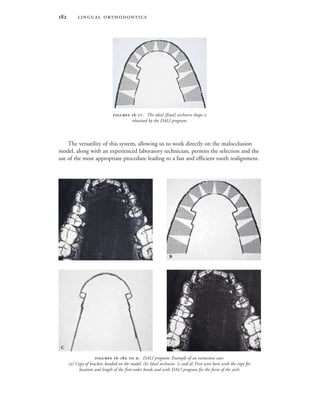  
The versatility of this system, allowing us to work directly on the malocclusion
model, along with an experienced laboratory technician, permits the selection and the
use of the most appropriate procedure leading to a fast and efficient tooth realignment.
 -  . DALI program: Example of an extraction case:
(a) Copy of brackets bonded on the model. (b) Ideal archwire. (c and d) First wire bent with the copy for
location and length of the first-order bends and with DALI program for the form of the arch.
 -. The ideal (final) archwire shape is
obtained by the DALI program.
 
 
 