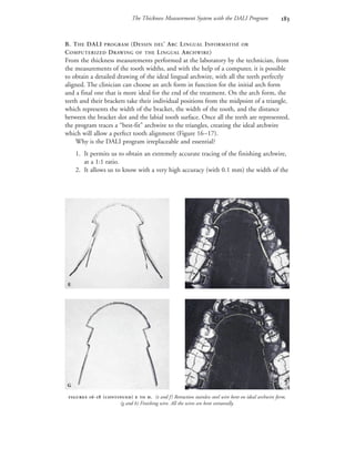 The Thickness Measurement System with the DALI Program 
B. THE DALI PROGRAM (DESSIN DEL’ ARC LINGUAL INFORMATISÉ OR
COMPUTERIZED DRAWING OF THE LINGUAL ARCHWIRE)
From the thickness measurements performed at the laboratory by the technician, from
the measurements of the tooth widths, and with the help of a computer, it is possible
to obtain a detailed drawing of the ideal lingual archwire, with all the teeth perfectly
aligned. The clinician can choose an arch form in function for the initial arch form
and a final one that is more ideal for the end of the treatment. On the arch form, the
teeth and their brackets take their individual positions from the midpoint of a triangle,
which represents the width of the bracket, the width of the tooth, and the distance
between the bracket slot and the labial tooth surface. Once all the teeth are represented,
the program traces a “best-fit” archwire to the triangles, creating the ideal archwire
which will allow a perfect tooth alignment (Figure 16–17).
Why is the DALI program irreplaceable and essential?
1. It permits us to obtain an extremely accurate tracing of the finishing archwire,
at a 1:1 ratio.
2. It allows us to know with a very high accuracy (with 0.1 mm) the width of the
 - ()   . (e and f) Retraction stainless steel wire bent on ideal archwire form.
(g and h) Finishing wire. All the wires are bent extraorally.
 
 
 
