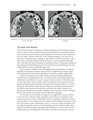 Lingual Treatment with the Bending Art System 
The Ideal Arch Method
The ideal arch method was adapted to lingual orthodontics from the labial technique.
The user selects the basic ideal arch shape which afterwards is automatically adapted
to the size of the patient’s dentition and displayed on the monitor in the occlusal view.
This arch shape is named “ideal arch” in the computer program. The values for all
parameters, including torque, angulation, and rotation, can either come from a select-
ed treatment technique (Andrews, Ricketts, Roth, etc.) or be specified individually.
Often, the ideal arch does not produce an optimal occlusion. Consequently, additional
three-dimensional individualization has to be performed for ideal finishing. This indi-
vidualized final archwire is called the target arch.
Due to the great variability of the tooth lingual surfaces, this method is not directly
applicable to the lingual arch shape. Because of this, a supplementary software, which
uses a labial reference arch, has been developed in cooperation with Dr. Didier Fillion.
Using the mesiodistal tooth widths and the measured individual labiolingual
distances from the lingual bracket slots to the labial surfaces (including bracket base
and thickness of adhesive), the system computes reference points on the labial surface
of each tooth. These reference points, which correspond to the slot positions of the
hypothetical labial brackets, determine the shape of the ideal arch (Figures 17–4 and 5).
Designing and bending of all the archwires takes into consideration the thickness of
the adhesive layer between the bracket base and the tooth surface. Therefore, the
adhesive layer thickness does not play a significant role, in contrast to other techniques
like the slot-machine that is based on the Straight Wire technique.3
If the brackets are not bonded according to the Straight Wire concept, specifica-
tion of corrective values for torque, angulation, and rotation are required to avoid
undesired tooth movements. Consequently, all these compensatory bends are created
automatically. For every single tooth, the computer allows editing of its position in the
three dimensions of space. Furthermore, since it is very easy to keep the original arch
size while changing the position of each individual tooth three-dimensionally, where
required, the most immediate advantage of the BAS becomes obvious when used for
detailing during the finishing phase of treatment. If further movements are necessary
 -. Occlusal view of the passive lingual arch on the
monitor of the BAS.
 -. Occlusal view of the target arch on the monitor
of the BAS.
 