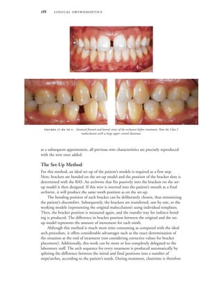  
at a subsequent appointment, all previous wire characteristics are precisely reproduced
with the new ones added.
The Set-Up Method
For this method, an ideal set-up of the patient’s models is required as a first step.
Next, brackets are bonded on the set-up model and the position of the bracket slots is
determined with the BAS. An archwire that fits passively into the brackets on the set-
up model is then designed. If this wire is inserted into the patient’s mouth as a final
archwire, it will produce the same tooth position as on the set-up.
The bonding position of each bracket can be deliberately chosen, thus minimizing
the patient’s discomfort. Subsequently, the brackets are transferred, one by one, to the
working models (representing the original malocclusion) using individual templates.
Then, the bracket position is measured again, and the transfer tray for indirect bond-
ing is produced. The difference in bracket position between the original and the set-
up model represents the amount of movement for each tooth.
Although this method is much more time consuming as compared with the ideal
arch procedure, it offers considerable advantages such as the exact determination of
the situation at the end of treatment (not considering corrective values for bracket
placement). Additionally, this work can be more or less completely delegated to the
laboratory staff. The arch sequence for every treatment is produced automatically by
splitting the difference between the initial and final positions into a number of
steps/arches, according to the patient’s needs. During treatment, chairtime is therefore
 -  . Intraoral frontal and lateral views of the occlusion before treatment. Note the Class I
malocclusion with a large upper central diastema.

 
 