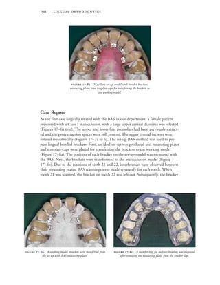  
Case Report
As the first case lingually treated with the BAS in our department, a female patient
presented with a Class I malocclusion with a large upper central diastema was selected
(Figures 17–6a to c). The upper and lower first premolars had been previously extract-
ed and the postextraction spaces were still present. The upper central incisors were
rotated mesiobucally (Figures 17–7a to b). The set-up BAS method was used to pre-
pare lingual bonded brackets. First, an ideal set-up was produced and measuring plates
and template-caps were placed for transferring the brackets to the working model
(Figure 17–8a). The position of each bracket on the set-up model was measured with
the BAS. Next, the brackets were transformed to the malocclusion model (Figure
17–8b). Due to the rotations of teeth 21 and 22, interferences were observed between
their measuring plates. BAS scannings were made separately for each tooth. When
tooth 21 was scanned, the bracket on tooth 22 was left out. Subsequently, the bracket
 -. Maxillary set-up model with bonded brackets,
measuring plates, and template-caps for transferring the brackets to
the working model.
 -. A working model. Brackets were transferred from
the set-up with BAS measuring plates.
 -. A transfer tray for indirect bonding was prepared,
after removing the measuring plates from the bracket slots.
 