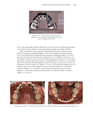Lingual Treatment with the Bending Art System 
for 21 was temporarily removed whereas the one for 22 was set, allowing the measure-
ment of this tooth in relation to the other brackets already scanned by the BAS.
After removing the measuring plates from the bracket slots, a transfer tray for
indirect bonding was produced (Figure 17–8c). The template-caps of the brackets
were covered with silicone (Memosil, Heraeus Kulzer, Dormagen, FRG). A total of
four wires for each jaw were bent for treating this case: two 0.016'' round wires and
two 0.016'' stainless steel wires. Each wire was designed by the BAS to carry the teeth
25% further towards their final position, as defined by the set-up. Every 4 weeks, the
subsequent archwire was put in (Figures 17–9a to c). The treatment progress was very
rapid, as one can see in the sequential views at 2 months (Figures 17–10a and b),
4 months (Figures 17–11a and b), and at the end of treatment, after 5 months
(Figures 17–12a and b). Satisfactory final results were achieved within 5 months
(Figure 17–13a to c).
 -. The upper 0.016 × 0.016 SS archwire,
completely passive in relation to the bracket slots on the set-up
model, as designed with the BAS.
 -  . Occlusal views of the maxillary arch and the mandibular arch: immediately after placing the wires.
 
 