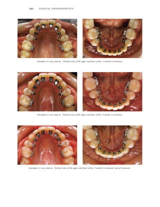  
 -  . Occlusal views of the upper and lower arches: 2 months in treatment.
 
 -  . Occlusal views of the upper and lower arches: 4 months in treatment.
 
 -  . Occlusal views of the upper and lower arches: 5 months in treatment (end of treatment).
 
 