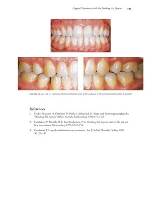 Lingual Treatment with the Bending Art System 
 -  . Intraoral frontal and lateral views of the occlusion at the end of treatment (after 5 months).

 
References
1. Fischer-Brandies H, Orthuber W, Pohle L, Sellenrieck D. Biege-und Torsionsgenauigkeit des
“Bending Art System” (BAS). Fortschr Kieferorthop 1996;57:16–23.
2. Cacciafesta V, Miethke R-R, Jost-Brinkmann, P-G. Bending Art System: state of the art and
first impressions. Kieferorthop 1995;9:247–254.
3. Creekmore T. Lingual orthodontics—its renaissance. Am J Orthod Dentofac Orthop 1989;
96:120–137.
 