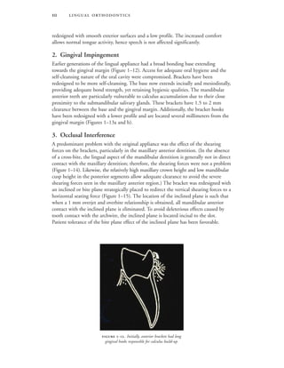  -. Initially, anterior brackets had long
gingival hooks responsible for calculus build-up.
 
redesigned with smooth exterior surfaces and a low profile. The increased comfort
allows normal tongue activity, hence speech is not affected significantly.
2. Gingival Impingement
Earlier generations of the lingual appliance had a broad bonding base extending
towards the gingival margin (Figure 1–12). Access for adequate oral hygiene and the
self-cleansing nature of the oral cavity were compromised. Brackets have been
redesigned to be more self-cleansing. The base now extends incisally and mesiodistally,
providing adequate bond strength, yet retaining hygienic qualities. The mandibular
anterior teeth are particularly vulnerable to calculus accumulation due to their close
proximity to the submandibular salivary glands. These brackets have 1.5 to 2 mm
clearance between the base and the gingival margin. Additionally, the bracket hooks
have been redesigned with a lower profile and are located several millimeters from the
gingival margin (Figures 1–13a and b).
3. Occlusal Interference
A predominant problem with the original appliance was the effect of the shearing
forces on the brackets, particularly in the maxillary anterior dentition. (In the absence
of a cross-bite, the lingual aspect of the mandibular dentition is generally not in direct
contact with the maxillary dentition; therefore, the shearing forces were not a problem
(Figure 1–14). Likewise, the relatively high maxillary crown height and low mandibular
cusp height in the posterior segments allow adequate clearance to avoid the severe
shearing forces seen in the maxillary anterior region.) The bracket was redesigned with
an inclined or bite plane strategically placed to redirect the vertical shearing forces to a
horizontal seating force (Figure 1–15). The location of the inclined plane is such that
when a 1 mm overjet and overbite relationship is obtained, all mandibular anterior
contact with the inclined plane is eliminated. To avoid deleterious effects caused by
tooth contact with the archwire, the inclined plane is located incisal to the slot.
Patient tolerance of the bite plane effect of the inclined plane has been favorable.
 
