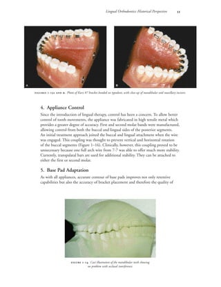Lingual Orthodontics: Historical Perspective 
4. Appliance Control
Since the introduction of lingual therapy, control has been a concern. To allow better
control of tooth movements, the appliance was fabricated in high tensile metal which
provides a greater degree of accuracy. First and second molar bands were manufactured,
allowing control from both the buccal and lingual sides of the posterior segments.
An initial treatment approach joined the buccal and lingual attachment when the wire
was engaged. This coupling was thought to prevent vertical and horizontal rotation
of the buccal segments (Figure 1–16). Clinically, however, this coupling proved to be
unnecessary because one full arch wire from 7-7 was able to offer much more stability.
Currently, transpalatal bars are used for additional stability. They can be attached to
either the first or second molar.
5. Base Pad Adaptation
As with all appliances, accurate contour of base pads improves not only retentive
capabilities but also the accuracy of bracket placement and therefore the quality of
 -. Cast illustration of the mandibular teeth showing
no problem with occlusal interference.
 
 -  . Photo of Kurz #7 bracket bonded on typodont, with close-up of mandibular and maxillary incisors.
 