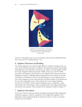  
treatment. Topographic maps were constructed for each tooth and individual bracket
base curvatures were calculated (Figure 1–17).
6. Appliance Placement and Bonding
The original appliances were direct bonded. With the variability of lingual tooth con-
tours, accurate bracket placement was difficult. This approach produced unpredictable
tooth alignment with tremendous variations in tip, torque, and tooth height. Initially,
the Torque Angulation Referencing Guide (TARG) system was used. The TARG
instrument was designed to place brackets on the lingual surfaces using conventional
landmarks as references. Although substantial improvements were made in the accuracy
and efficiency of bonding, the system was still inadequate. A more sophisticated sys-
tem, using a diagnostic set-up constructed from articulated models was developed and
has met with considerable success. This method, the Custom Lingual Appliance
Set-Up Service (CLASS), involves indirect bonding set-up on a diagnostic or ideal
model of the teeth. The brackets are then transferred back to the original malocclusion,
and transfer trays prepared. These methods will be explained in detail in Chapter 15.
7. Appliance Prescription
In the early 1970s, Dr. Lawrence Andrews developed and patented a fully programmed
orthodontic appliance, which he introduced as the Straight Wire Appliance. This
philosophy involves programming all the elements necessary to achieve an optimal
occlusion into each bracket.
 -. The incline plane. The red arrows
represent the primary force applied, and the broken
black lines represent the secondary/resultant
forces exerted.
 
