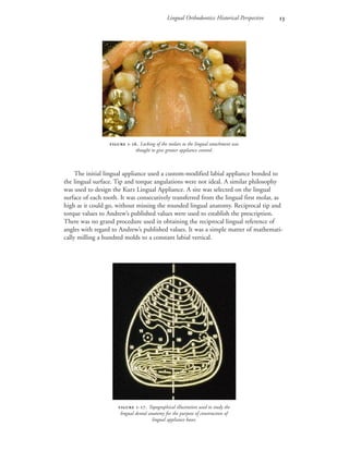 Lingual Orthodontics: Historical Perspective 
The initial lingual appliance used a custom-modified labial appliance bonded to
the lingual surface. Tip and torque angulations were not ideal. A similar philosophy
was used to design the Kurz Lingual Appliance. A site was selected on the lingual
surface of each tooth. It was consecutively transferred from the lingual first molar, as
high as it could go, without missing the rounded lingual anatomy. Reciprocal tip and
torque values to Andrew’s published values were used to establish the prescription.
There was no grand procedure used in obtaining the reciprocal lingual reference of
angles with regard to Andrew’s published values. It was a simple matter of mathemati-
cally milling a hundred molds to a constant labial vertical.
 -. Locking of the molars to the lingual attachment was
thought to give greater appliance control.
 -. Topographical illustration used to study the
lingual dental anatomy for the purpose of construction of
lingual appliance bases.
 