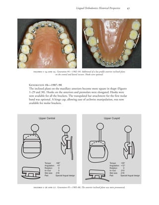 Lingual Orthodontics: Historical Perspective 
GENERATION #6—1987–90
The inclined plane on the maxillary anteriors become more square in shape (Figures
1–29 and 30). Hooks on the anteriors and premolars were elongated. Hooks were
now available for all the brackets. The transpalatal bar attachment for the first molar
band was optional. A hinge cap, allowing ease of archwire manipulation, was now
available for molar brackets.
 -  . Generation #4—1982–84. Additional of a low profile anterior inclined plane
on the central and lateral incisors. Hooks were optional.
 -  . Generation #5—1985–86. The anterior inclined plane was more pronounced,
Upper Central
Torque: +68°
Angulation: +5°
Rotation: 0
In–Out: 0
Slot size: .018
Pad: Special lingual design
Upper Cuspid
Torque: +55°
Angulation: +12°
Rotation: 0
In–Out: .010
Slot size: .018
Pad: Special lingual design
 