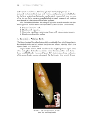  
nathic system is maintained. Clinical judgment of treatment progress can be
enhanced. Evaluation of individual tooth positions can be easily accomplished by hav-
ing the labial surfaces free of distracting metal or plastic brackets. Soft tissue responses
of the lips and cheeks to treatment can be judged accurately because there is no distor-
tion of shape or irritation caused by a labial appliance.
Four distinct situations exist where lingual appliances may be more effective than
labial appliances because of their unique mechanical characteristics. These include:
1. Intrusion of anterior teeth.
2. Maxillary arch expansion.
3. Combining mandibular repositioning therapy with orthodontic movements.
4. Distalization of maxillary molars.
1. Intrusion of Anterior Teeth
The biomechanics of lingual techniques differ considerably from labial biomechanics.
Both arch circumference and interbracket distance are reduced, requiring lighter force
application for tooth movement.5–9
Lingual bracket position, which is dictated by the morphology of the lingual surface
of the tooth, places the bracket closer to the center of resistance of the tooth than is
found with labial bracket placement (Figure 2–1).10
An important clinical implication
of this unique bracket position and design is that the intrusive force vector is directed
 -. The center of resistance of the tooth is
located closer to the lingual bracket.
 