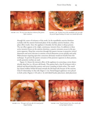 Present Clinical Reality 
through the center of resistance of the tooth. As the mandibular anterior dentition
occludes with the anterior horizontal plane of the maxillary anterior brackets, a bite
plane effect results. Since the appliance is bonded, the bite plane is always present.
The net effect appears to be a light, continuous, intrusive force. In addition to these
active intrusive forces on the anterior dentition, a passive extrusion occurs in the pos-
terior segments. Deep-bite correction through this passive increase in posterior vertical
dimension and active decrease in anterior vertical dimension occurs quickly and easily.
Malocclusions requiring open-bite correction obviously would not benefit from this
technique. To prevent the passive extrusion of the posterior segments in these patients,
acrylic posterior overlays are used.
Figure 2–2 shows the intrusive effect of the appliance in correcting a severe dento-
alveolar deep bite in a 38-year-old female. This patient had a class II occlusion with a
skeletal and dental deep-bite pattern and severe crowding in both arches. The maxil-
lary dental midline looked deviated towards the left-hand side because of the extreme
Class II relationship on that side (Figure 2–2a). Partial lingual appliances were placed
in both arches (Figures 2–2b and c). As with labial bracket placement, ideal placement
 -. The very severe deep-bite occlusion of the patient,
before treatment.
 -. Occlusal view of the mandibular arch, just after
the partial lingual bonding; the molars were banded afterwards.
 -. The upper arch, just after the initial partial
lingual bonding.
 -. Frontal intraoral view, three months after
starting lingual mechanics.
 