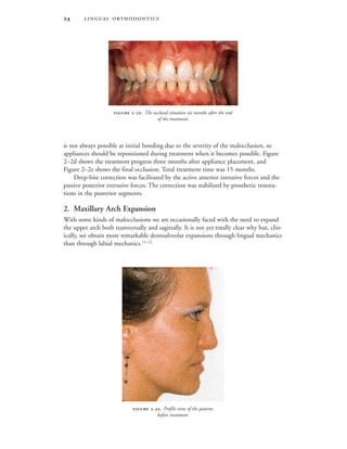  
is not always possible at initial bonding due to the severity of the malocclusion, so
appliances should be repositioned during treatment when it becomes possible. Figure
2–2d shows the treatment progress three months after appliance placement, and
Figure 2–2e shows the final occlusion. Total treatment time was 15 months.
Deep-bite correction was facilitated by the active anterior intrusive forces and the
passive posterior extrusive forces. The correction was stabilized by prosthetic restora-
tions in the posterior segments.
2. Maxillary Arch Expansion
With some kinds of malocclusions we are occasionally faced with the need to expand
the upper arch both transversally and sagittally. It is not yet totally clear why but, clin-
ically, we obtain more remarkable dentoalveolar expansions through lingual mechanics
than through labial mechanics.11–12
 -. The occlusal situation six months after the end
of the treatment.
 -. Profile view of the patient,
before treatment.
 