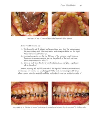 Present Clinical Reality 
Some possible reasons are:
1. The force which is developed is of a centrifugal type, from the inside towards
the outside of the arch. The same occurs with the Quad-Helix and the Rapid
Palatal Expansion (RPE) devices.
2. Some authors point out that the thickness of the brackets, which interpose
themselves between the tongue and the lingual wall of the teeth, can con-
tribute to this expansive effect.7–9
3. It is even likely that the shorter interbracket distance may play a significant
role in this effect.5
In fact, by using this method, not only is the expansive effect so evident but also
the teeth do not become too labially tipped.10
The tooth movement probably takes
place without incurring a significant labial inclination because the application point of
 -  . Lower and upper occlusal photographs, before treatment.
 
 -‒. Right and left intraoral views, during the initial phases of mechanics, after the extraction of the first lower molars.
 
 
