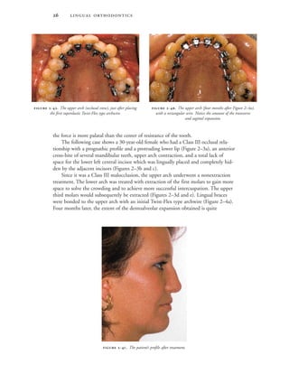  
the force is more palatal than the center of resistance of the tooth.
The following case shows a 30-year-old female who had a Class III occlusal rela-
tionship with a prognathic profile and a protruding lower lip (Figure 2–3a), an anterior
cross-bite of several mandibular teeth, upper arch contraction, and a total lack of
space for the lower left central incisor which was lingually placed and completely hid-
den by the adjacent incisors (Figures 2–3b and c).
Since it was a Class III malocclusion, the upper arch underwent a nonextraction
treatment. The lower arch was treated with extraction of the first molars to gain more
space to solve the crowding and to achieve more successful intercuspation. The upper
third molars would subsequently be extracted (Figures 2–3d and e). Lingual braces
were bonded to the upper arch with an initial Twist-Flex type archwire (Figure 2–4a).
Four months later, the extent of the dentoalveolar expansion obtained is quite
 -. The upper arch (occlusal view), just after placing
the first superelastic Twist-Flex type archwire.
 -. The upper arch (four months after Figure 2–4a),
with a rectangular wire. Notice the amount of the transverse
and sagittal expansion.
 -. The patient’s profile after treatment.
 