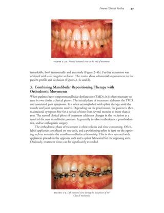 Present Clinical Reality 
remarkable, both transversally and anteriorly (Figure 2–4b). Further expansion was
achieved with a rectangular archwire. The results show substantial improvement in the
patient profile and occlusion (Figures 2–4c and d).
3. Combining Mandibular Repositioning Therapy with
Orthodontic Movements
When patients have temporomandibular dysfunction (TMD), it is often necessary to
treat in two distinct clinical phases. The initial phase of treatment addresses the TMD
and associated pain symptoms. It is often accomplished with splint therapy until the
muscle and joint symptoms resolve. Depending on the practitioner, the patient is then
maintained, symptom free for a period of time from several months to more than a
year. The second clinical phase of treatment addresses changes in the occlusion as a
result of the new mandibular position. It generally involves orthodontics, prosthodon-
tics, and/or orthognatic surgery.
The orthodontic phase of treatment is often tedious and time consuming. Often,
labial appliances are placed on one arch, and a positioning splint is kept on the oppos-
ing arch to maintain the maxillomandibular relationship. This is then reversed with
appliances placed on the opposite arch and a splint fabricated for the opposing arch.
Obviously, treatment times can be significantly extended.
 -. Frontal intraoral view at the end of treatment.
 -. Left intraoral view during the last phases of the
Class II mechanics.
 