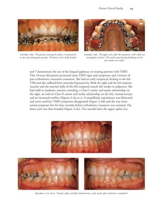 Present Clinical Reality 
and 7 demonstrate the use of the lingual appliance in treating patients with TMD.
This 18-year-old patient presented some TMD signs and symptoms and a history of
past orthodontic extraction treatment. She had an early reciprocal clicking in the left
TMJ and also suffered from muscular hyperactivity. Both the right and the left masseter
muscles and the anterior belly of the left temporal muscle felt tender to palpation. She
had mild to moderate anterior crowding, a Class I canine and molar relationship on
the right, an end-on Class II canine and molar relationship on the left, normal overjet,
and an increased overbite (Figures 2–6a to c). A mandibular repositioner was fabricated
and worn until her TMD symptoms disappeared (Figure 2–6d) and she was main-
tained symptom free for four months before orthodontic treatment was initiated. The
lower arch was then bonded (Figure 2–6e). Two months later the upper splint was
 -. The patient, wearing the splint, is maintained
in the same therapeutic position. The lower arch is fully bonded.
 -. The upper arch, after the expansion, with a full size
rectangular archwire. The acrylic repositioning build-ups on the
first molars are visible.


 -  . Frontal, right, and left intraoral views, a few weeks after treatment is completed.

 