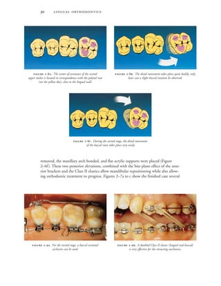  
removed, the maxillary arch bonded, and flat acrylic supports were placed (Figure
2–6f). These two posterior elevations, combined with the bite plane effect of the ante-
rior brackets and the Class II elastics allow mandibular repositioning while also allow-
ing orthodontic treatment to progress. Figures 2–7a to c show the finished case several
 -. The center of resistance of the second
upper molar is located in correspondence with the palatal root
(see the yellow dot), close to the lingual wall.
 -. During the second stage, the distal movement
of the buccal roots takes place very easily.
 -. The distal movement takes place quite bodily; only
later can a slight buccal rotation be observed.
 -. For the second stage, a buccal sectional
archwire can be used.
 -. A doubled Class II elastic (lingual and buccal)
is very effective for the retracting mechanics.
 