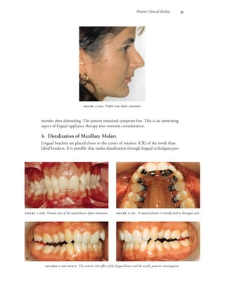 Present Clinical Reality 
months after debonding. The patient remained symptom free. This is an interesting
aspect of lingual appliance therapy that warrants consideration.
4. Distalization of Maxillary Molars
Lingual brackets are placed closer to the center of rotation (CR) of the tooth than
labial brackets. It is possible that molar distalization through lingual techniques pro-
 -. Profile view before treatment.
 -. Frontal view of the malocclusion before treatment.  -. A round archwire is initially used in the upper arch.
 -  . The anterior bite effect of the lingual braces and the acrylic posterior minisupports.
 
 