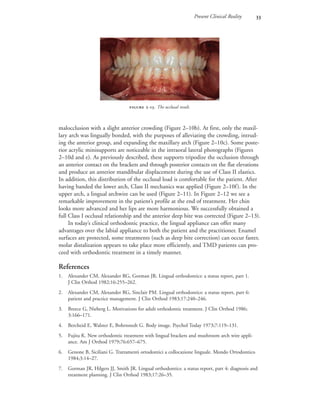 Present Clinical Reality 
malocclusion with a slight anterior crowding (Figure 2–10b). At first, only the maxil-
lary arch was lingually bonded, with the purposes of alleviating the crowding, intrud-
ing the anterior group, and expanding the maxillary arch (Figure 2–10c). Some poste-
rior acrylic minisupports are noticeable in the intraoral lateral photographs (Figures
2–10d and e). As previously described, these supports tripodize the occlusion through
an anterior contact on the brackets and through posterior contacts on the flat elevations
and produce an anterior mandibular displacement during the use of Class II elastics.
In addition, this distribution of the occlusal load is comfortable for the patient. After
having banded the lower arch, Class II mechanics was applied (Figure 2–10f). In the
upper arch, a lingual archwire can be used (Figure 2–11). In Figure 2–12 we see a
remarkable improvement in the patient’s profile at the end of treatment. Her chin
looks more advanced and her lips are more harmonious. We successfully obtained a
full Class I occlusal relationship and the anterior deep bite was corrected (Figure 2–13).
In today’s clinical orthodontic practice, the lingual appliance can offer many
advantages over the labial appliance to both the patient and the practitioner. Enamel
surfaces are protected, some treatments (such as deep bite correction) can occur faster,
molar distalization appears to take place more efficiently, and TMD patients can pro-
ceed with orthodontic treatment in a timely manner.
References
1. Alexander CM, Alexander RG, Gorman JR. Lingual orthodontics: a status report, part 1.
J Clin Orthod 1982;16:255–262.
2. Alexander CM, Alexander RG, Sinclair PM. Lingual orthodontics: a status report, part 6:
patient and practice management. J Clin Orthod 1983;17:240–246.
3. Breece G, Nieberg L. Motivations for adult orthodontic treatment. J Clin Orthod 1986;
3:166–171.
4. Bercheid E, Walster E, Bohrnstedt G. Body image. Psychol Today 1973;7:119–131.
5. Fujita K. New orthodontic treatment with lingual brackets and mushroom arch wire appli-
ance. Am J Orthod 1979;76:657–675.
6. Genone B, Siciliani G. Trattamenti ortodontici a collocazione linguale. Mondo Ortodontico
1984;3:14–27.
7. Gorman JR, Hilgers JJ, Smith JR. Lingual orthodontics: a status report, part 4: diagnosis and
treatment planning. J Clin Orthod 1983;17:26–35.
 -. The occlusal result.
 