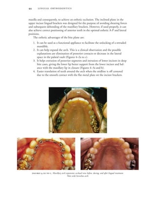  
maxilla and consequently, to achieve an esthetic occlusion. The inclined plane in the
upper incisor lingual brackets was designed for the purpose of avoiding shearing forces
and subsequent debonding of the maxillary brackets. However, if used properly, it can
also achieve correct positioning of anterior teeth in the optimal esthetic A-P and lateral
positions.
The esthetic advantages of the bite plane are:
1. It can be used as a functional appliance to facilitate the unlocking of a retruded
mandible.
2. It can help expand the arch. This is a clinical observation and the possible
explanations are elimination of posterior contacts or decrease in the lateral
space in the palatal vault (Figures 4–2a to c).
3. It helps extrusion of posterior segments and intrusion of lower incisors in deep
bite cases, giving the lower lip better support from the lower incisor and bal-
ance with the maxillary lip in closure (Figures 4–3a and b).
4. Easier translation of teeth around the arch when the midline is off centered
due to the smooth contact with the flat metal plate on the incisor brackets.
 -  . Maxillary arch expansion: occlusal view before, during, and after lingual treatment.
Note wide horseshoe arch.

 
 