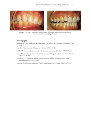 Enhanced Facial Esthetics using Kurz Lingual Appliance 
Bibliography
Bowbeer GRN. The five keys to facial beauty and TMJ health. The Functional Orthodontist 1985;
2:12–29.
Eirew HL. An orthodontic challenge. Int J Orthod 1976;14:21–25.
Liddle DW. Second molar extraction in orthodontic treatment. Am J Orthod 1977;72:599–616.
Luzi V. The CV value (combines variation) in the analysis of sagittal malocclusions. Am J Orthod
1982;81:478–480.
McNamara JC. Components of Class II malocclusion in children 8–10 years of age. Angle
Orthodontists, 1981;51:177–202.
Moyers et al. Differential diagnosis of Class II malocclusions. Am J Orthod 1980;78:477–494.
 -  . Extrusion of posterior segments and intrusion of lower incisors in deep bite case:
occlusal view before and during lingual treatment.
 
 