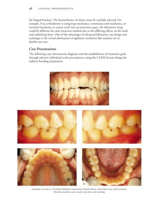  
the lingual brackets. The biomechanics of choice must be carefully selected. For
example, if an orthodontist is using loop mechanics, continuous arch mechanics, or
sectional mechanics to retract teeth into an extraction space, the laboratory setup
could be different for each retraction method due to the differing effects on the teeth
and underlying bone. One of the advantages of advanced laboratory case design and
technique is the virtual elimination of appliance auxiliaries like rotation ties or
double over-ties.
Case Presentations
The following cases demonstrate diagnosis and the establishment of treatment goals
through selective individual tooth prescriptions, using the CLASS System design for
indirect bonding preparation.
 -  . At initial orthodontic examination: frontal, lateral, and occlusal views of the occlusion.
Note the unesthetic smile, anterior open bite, and crowding.

 
 
 
