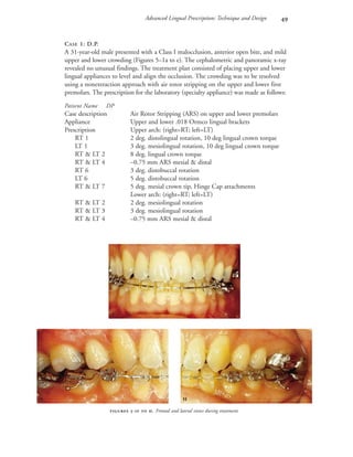 Advanced Lingual Prescription: Technique and Design 
CASE 1: D.P.
A 31-year-old male presented with a Class I malocclusion, anterior open bite, and mild
upper and lower crowding (Figures 5–1a to e). The cephalometric and panoramic x-ray
revealed no unusual findings. The treatment plan consisted of placing upper and lower
lingual appliances to level and align the occlusion. The crowding was to be resolved
using a nonextraction approach with air rotor stripping on the upper and lower first
premolars. The prescription for the laboratory (specialty appliance) was made as follows:
Patient Name DP
Case description Air Rotor Stripping (ARS) on upper and lower premolars
Appliance Upper and lower .018 Ormco lingual brackets
Prescription Upper arch: (right=RT; left=LT)
RT 1 2 deg. distolingual rotation, 10 deg lingual crown torque
LT 1 3 deg. mesiolingual rotation, 10 deg lingual crown torque
RT & LT 2 8 deg. lingual crown torque
RT & LT 4 –0.75 mm ARS mesial & distal
RT 6 3 deg. distobuccal rotation
LT 6 5 deg. distobuccal rotation
RT & LT 7 5 deg. mesial crown tip, Hinge Cap attachments
Lower arch: (right=RT; left=LT)
RT & LT 2 2 deg. mesiolingual rotation
RT & LT 3 3 deg. mesiolingual rotation
RT & LT 4 –0.75 mm ARS mesial & distal
 -  . Frontal and lateral views during treatment.

 
 