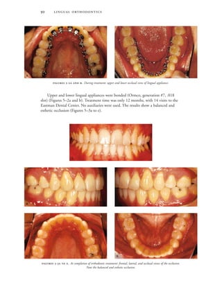  
Upper and lower lingual appliances were bonded (Ormco, generation #7, .018
slot) (Figures 5–2a and b). Treatment time was only 12 months, with 14 visits to the
Eastman Dental Center. No auxiliaries were used. The results show a balanced and
esthetic occlusion (Figures 5–3a to e).
 -  . At completion of orthodontic treatment: frontal, lateral, and occlusal views of the occlusion.
Note the balanced and esthetic occlusion.

 
 
 -  . During treatment: upper and lower occlusal view of lingual appliance.
 
 