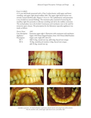 Advanced Lingual Prescription: Technique and Design 
CASE 2: A.M.C.
A 31-year-old female presented with a Class I malocclusion, mild upper and lower
crowding, and upper right dental midline shift. The upper right lateral incisor was
severely rotated distobuccally. (Figures 5–4a to e). The cephalometric and panoramic
x-ray revealed no unusual findings. The treatment plan consisted of extracting the
maxillary right first premolar to alleviate crowding and aid in the midline correction.
The occlusal plane was to be leveled. Continuous arch mechanics were to be used for
extraction space closure. The prescription for the laboratory (specialty appliance) was
made as follows:
Patient Name AMC
Case description Extraction upper right 4. Retraction with continuous arch mechanics
Appliance Upper .018 Ormco lingual brackets, lower .022 Ormco labial brackets
Prescription Upper arch: (right=RT; left=LT)
RT 7 Add 14 deg. mesial root tip, add 6 deg. buccal root torque
RT 6 18 deg. mesiobuccal rotation, 6 deg. buccal root torque,
add 18 deg. mesial root tip
 -  . At initial orthodontic examination: frontal, lateral, and occlusal views of the occlusion.
Note the unesthetic smile, rotated upper right lateral incisor, and midline shift.

 
 
 