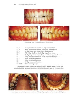  
RT 5 4 deg. mesiobuccal rotation, 15 deg. mesial root tip
RT 3 8 deg. mesiolingual rotation, add 12 deg. distal root tip
RT 2 12 deg. lingual root torque, 5 deg. distal root tip
RT 1 Add 2 deg. distal root tip, 11 deg. lingual root torque
LT 1 11 deg. lingual root torque, 8 deg. mesial root tip, intrude 1 mm
LT 2 6 deg. mesiobuccal rotation, 10 deg. lingual root torque
LT 3 6 deg. mesiobuccal rotation
LT 5 9 deg. mesiobuccal rotation
LT 6 12 deg. mesiobuccal rotation
RT & LT 7 Please use Hinge Caps.
The appliances chosen consisted of maxillary lingual brackets (Ormco, .018) and
mandibular labial appliances (Ormco, .018 Spirit) (Figures 5–5a to b). Treatment time
 -  . During treatment: occlusal views of the upper lingual appliance and lower transparent labial appliance.
 
 -  . Frontal and lateral views during treatment.

 
 