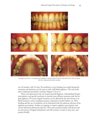 Advanced Lingual Prescription: Technique and Design 
 -  . At completion of orthodontic treatment: frontal, lateral, and occlusal views of the occlusion.
Note the balanced and esthetic occlusion.

 
 
was 18 months, with 18 visits. No auxiliaries or wire bending was needed during the
treatment and chairtime was the same as with a full labial appliance. The end results
show a balanced and esthetic occlusion (Figures 5–6a to e).
These cases demonstrate the use of goal-oriented diagnosis, individualized bracket
prescriptions, and specific mechanics to provide more efficient treatment with the lin-
gual appliance. Of course, lingual treatment can be affected by the same factors as in
labial treatment, such as inadequate patient cooperation, bracket failures, etc. Wire
bending and the use of auxiliaries can be eliminated with the judicious selection of the
appliance prescription. Studies are ongoing to improve appliance prescriptions and
custom laboratory-fabricated archwires. These and continued studies will advance the
art and science of lingual orthodontics and will continue to make it more user- and
patient-friendly.
 