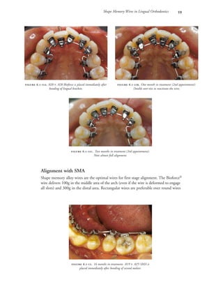 Shape Memory Wires in Lingual Orthodontics 
Alignment with SMA
Shape memory alloy wires are the optimal wires for first stage alignment. The Bioforce®
wire delivers 100g in the middle area of the arch (even if the wire is deformed to engage
all slots) and 300g in the distal area. Rectangular wires are preferable over round wires
 .-. One month in treatment (2nd appointment):
Double over-ties to reactivate the wire.
 .-. Two months in treatment (3rd appointment).
Note almost full alignment.
 .-. 16 months in treatment: .019 × .025 SMA is
placed immediately after bonding of second molars.
 .-. 020 × .020 Bioforce is placed immediately after
bonding of lingual brackets.
 